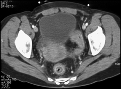 Ulcerative Colitis - CTisus CT Scan