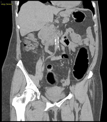 Ulcerative Colitis - CTisus CT Scan