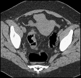 Apple Core Lesion - CTisus CT Scan