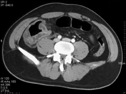 Ischemic Colitis in the Cecum - CTisus CT Scan