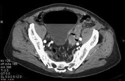 Diverticulitis - CTisus CT Scan