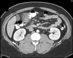 Colon Cancer - CTisus CT Scan