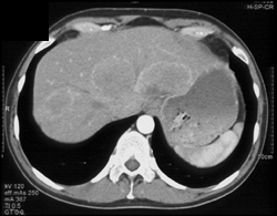 Melanoma Mets to Liver - CTisus CT Scan