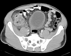 Cecal Cancer - CTisus CT Scan