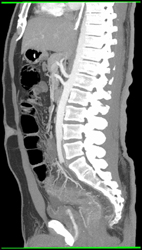 Inflammatory Bowel Disease (IBD) With Enhancing Branch Vessels - CTisus CT Scan