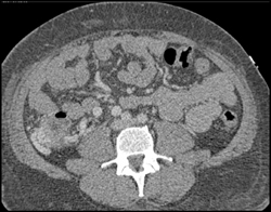 Varices Around Cecum - CTisus CT Scan