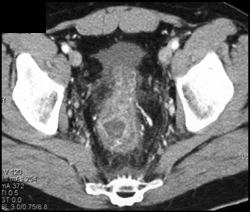 Ischemic Colitis - CTisus CT Scan