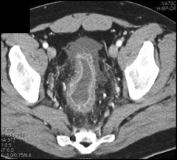 Ischemic Colitis - CTisus CT Scan