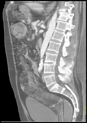 Ischemic Colitis - CTisus CT Scan