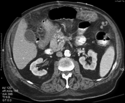 Colon Cancer With Proximal Ischemia - CTisus CT Scan