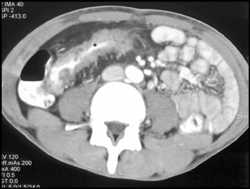 Ulcerative Colitis - CTisus CT Scan