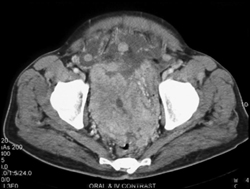 Gist Infiltrates the Pelvis - CTisus CT Scan