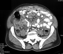 Carcinomatosis - CTisus CT Scan
