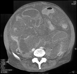 Pseudomyxoma Peritonei (PMP) - CTisus CT Scan