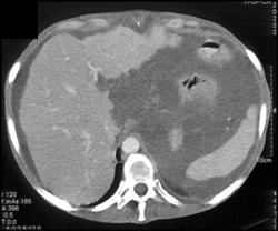 Pseudomyxoma Peritonei (PMP) - CTisus CT Scan