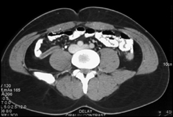 Dilated Appendix - CTisus CT Scan