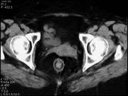 Perforated Rectum on Colonoscopy - CTisus CT Scan