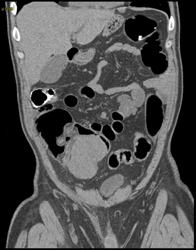 Virtual Colon With Cecal Mass - CTisus CT Scan
