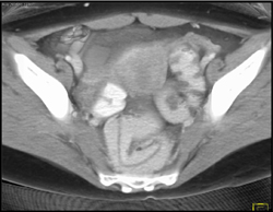 Sporotrichosis Colon - CTisus CT Scan