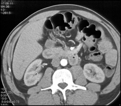 Cancer in Transverse Colon - CTisus CT Scan