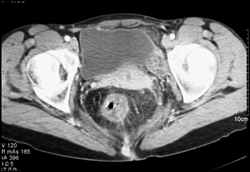 Perirectal Inflammation - CTisus CT Scan