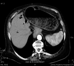 Pneumatosis Coli With Distended Small Bowel - CTisus CT Scan