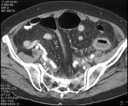 Diverticulitis - CTisus CT Scan