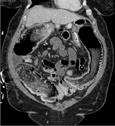 Ischemic Colitis - CTisus CT Scan