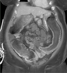 Ischemic Colitis - CTisus CT Scan