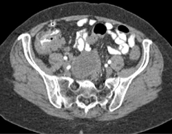 Cecal Cancer - CTisus CT Scan