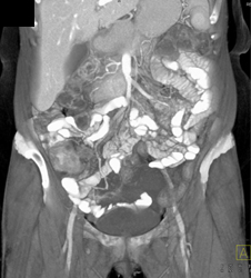 Cecal Cancer - CTisus CT Scan