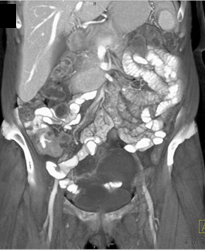 Cecal Cancer - CTisus CT Scan