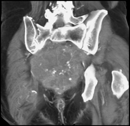 Recurrent Colon Cancer Invades Sacrum - CTisus CT Scan