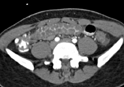 Pseudomembranous Colitis (PMC) - CTisus CT Scan