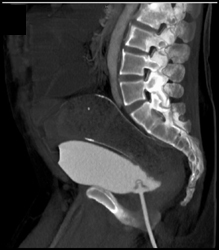 Rectal Cancer Invades the Bladder - CTisus CT Scan