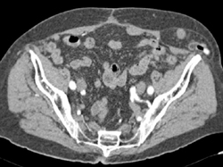 Left Spigelian Hernia - CTisus CT Scan