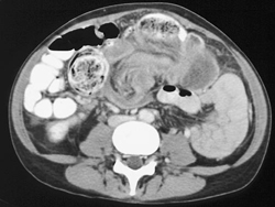 Intussusception - CTisus CT Scan