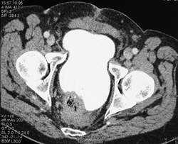 Rectal Cancer - CTisus CT Scan