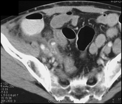 Appendicitis - CTisus CT Scan