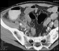 Appendicitis - CTisus CT Scan