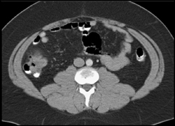 Cecal Diverticulitis - CTisus CT Scan