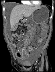 Pseudomembranous Colitis (PMC) - CTisus CT Scan