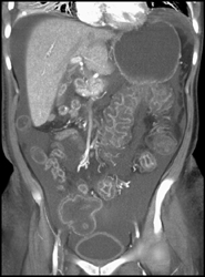 Pseudomembranous Colitis (PMC) - CTisus CT Scan