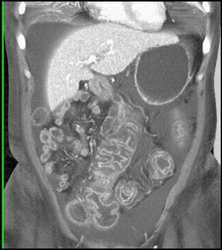 Pseudomembranous Colitis (PMC) - CTisus CT Scan