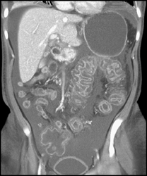 Pseudomembranous Colitis (PMC) - CTisus CT Scan