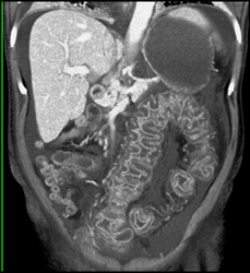 Pseudomembranous Colitis (PMC) - CTisus CT Scan