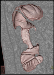 Carcinoma of the Splenic Flexure-apple Core Lesion - CTisus CT Scan