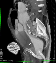 Bladder Pushed By Distended Colon - CTisus CT Scan