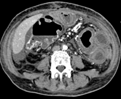 Pseudomembranous Colitis (PMC) - CTisus CT Scan