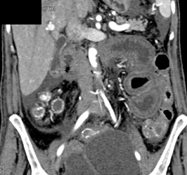 Pseudomembranous Colitis (PMC) - CTisus CT Scan